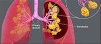🫁 Lung Detox Tips: When Lungs Feel Weakened Due to Smoking